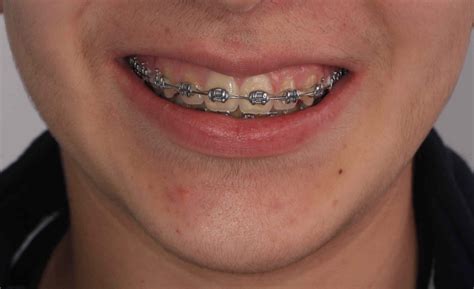 cuanto valen los brackets metalicos|ortodoncia brackets precio.